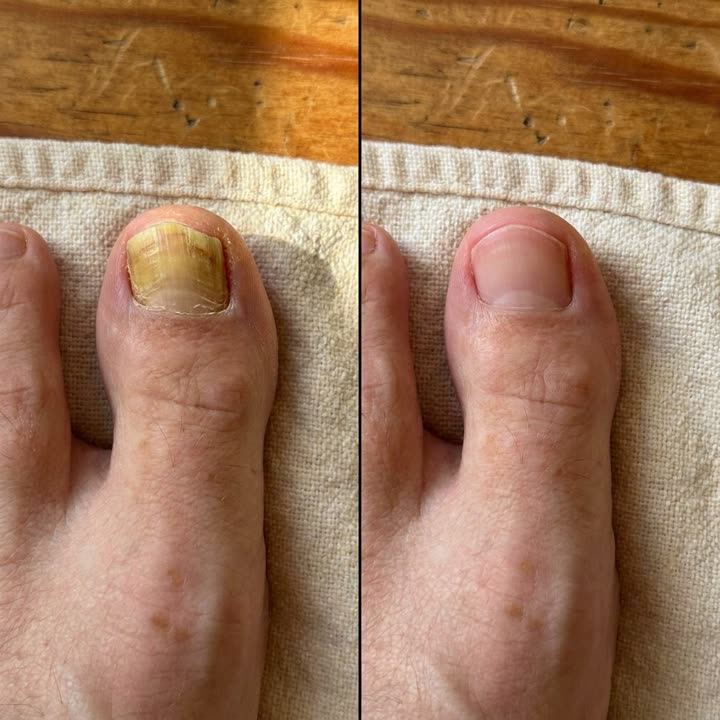 Step 3: before-and-after showing the yellow fading and clear new nail growth coming in at the base
