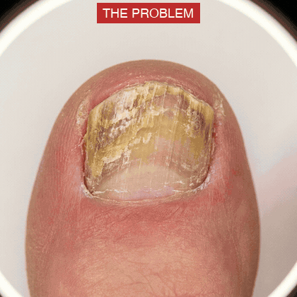 NailScience mechanism animation — the problem, Step 1 soften, antifungal kills the fungus, Week 6 clear