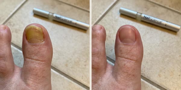 Sharon R. — before and after 90 days