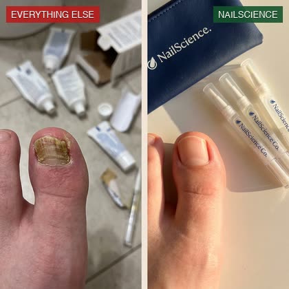 Same foot, split comparison: on the left a severely fungal big toenail with a scatter of used and failed competitor tubes in the background; on the right the same foot with a perfectly healthy pink nail and the NailScience 2-step kit beside it
