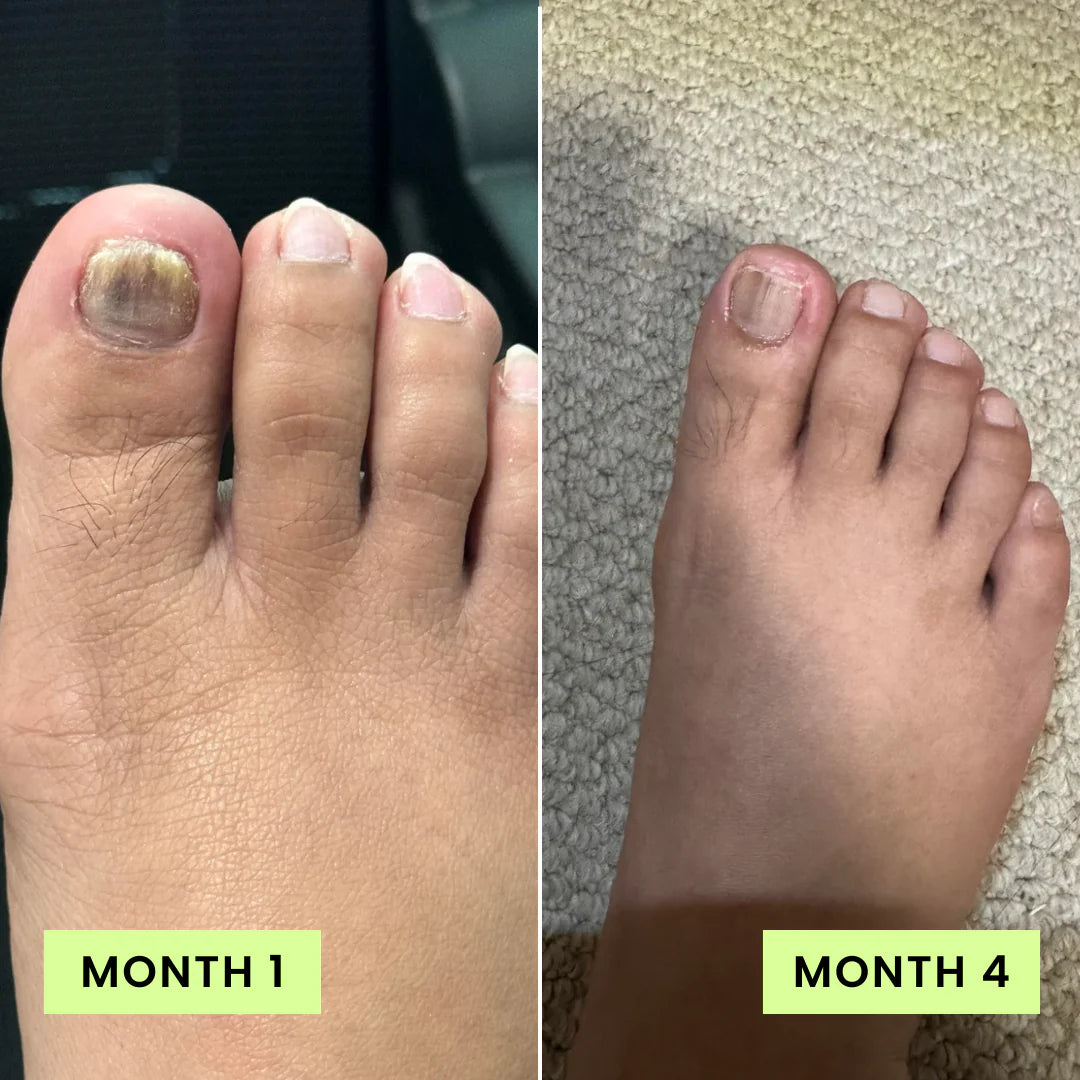 Before and after Month 1 vs Month 4