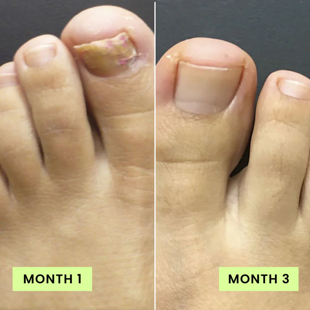 Before and after Month 1 vs Month 3