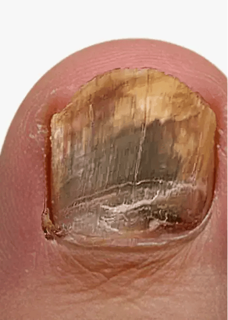 Toenail fungus close-up